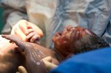 A baby is delivered by c-section at BMC